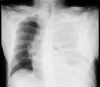 Hemothorax CXR